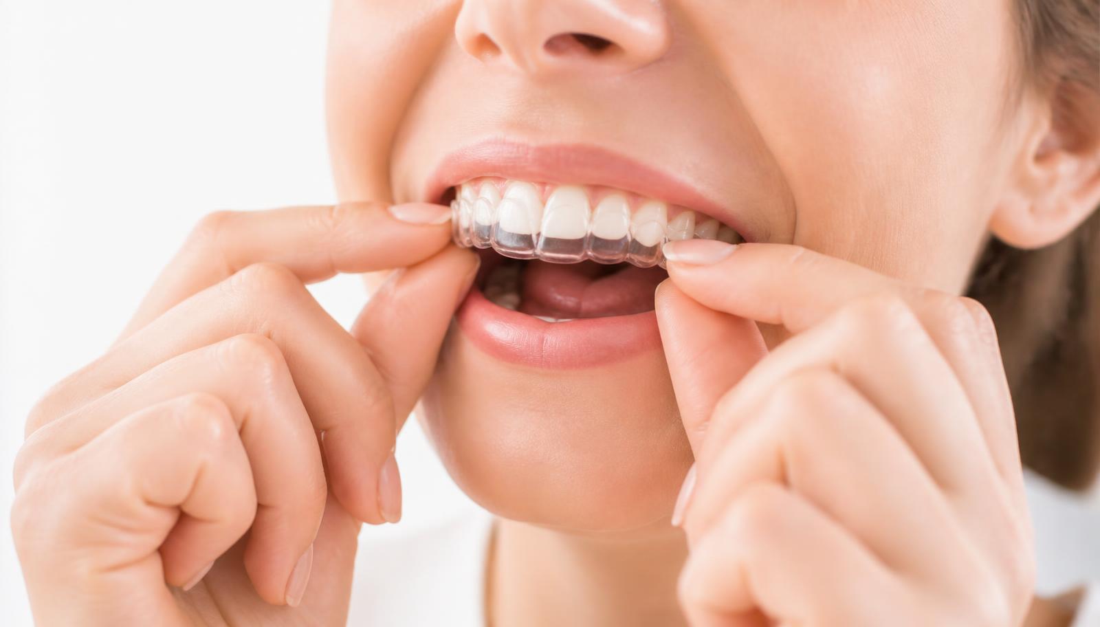 A patient placing a clear removable aligner tray over the upper teeth